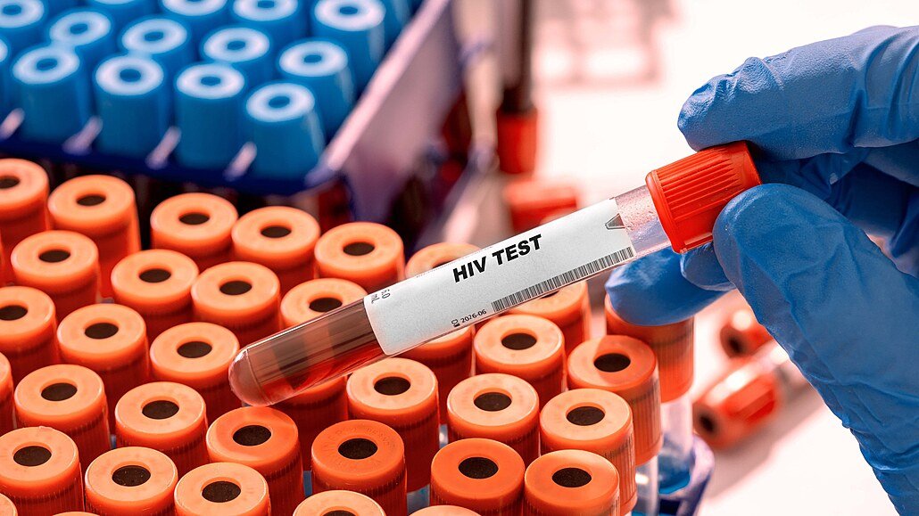 HIV v Česku dál přibývá. Případy nejsou jen ve velkých městech, týkají se i Pardubického kraje